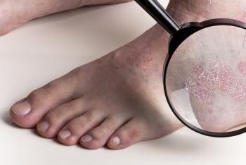 Причины, лечение и профилактика шелушения кожи на ногах